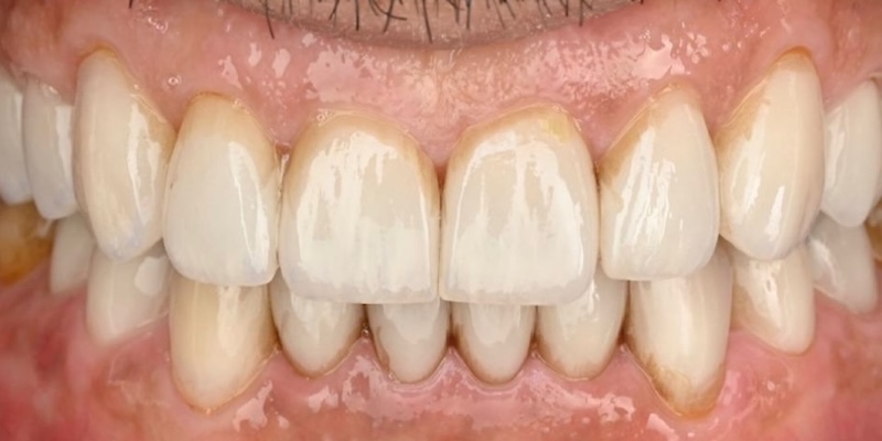 After: full mouth reconstruction with veneers, crowns, and implants