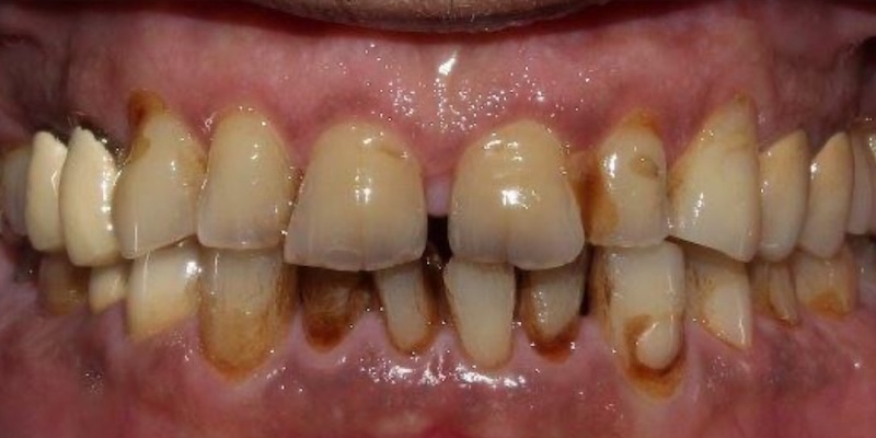 Before: full mouth reconstruction case
