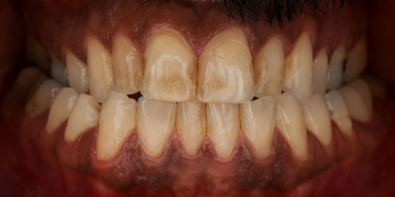 Before: worn teeth with open bite and reverse smile
