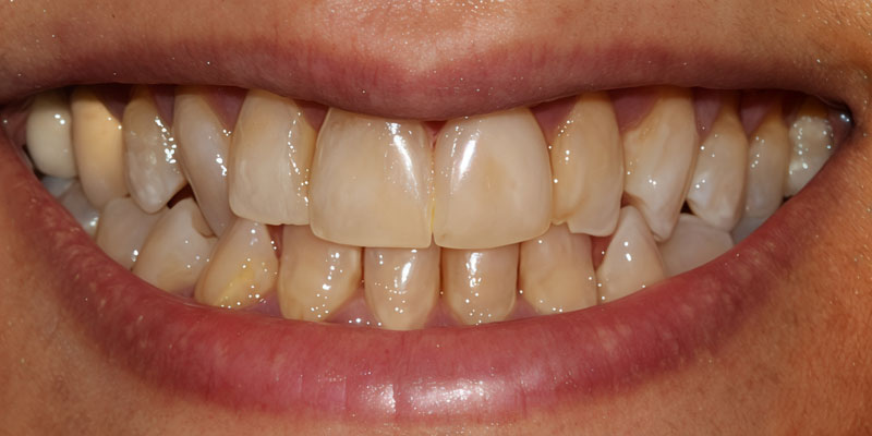 Before: compromised smile needing periodontal, orthodontic, and restorative care