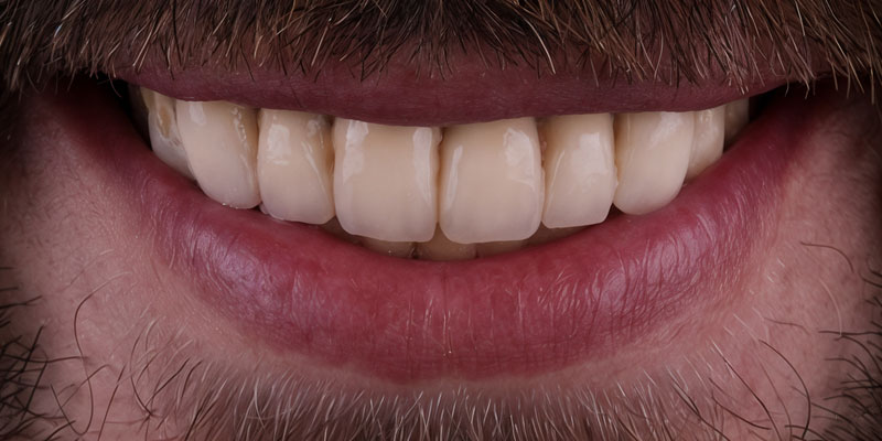 Before: misaligned and discolored teeth