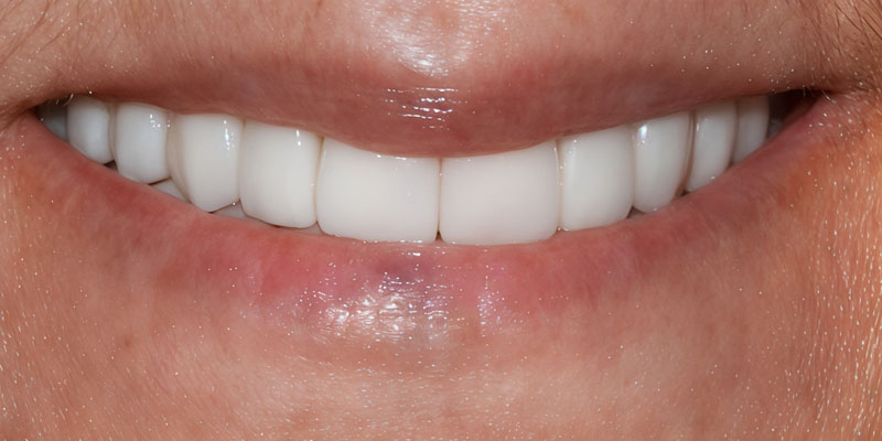 After: replacement of anterior crowns and veneers correcting alignment and color