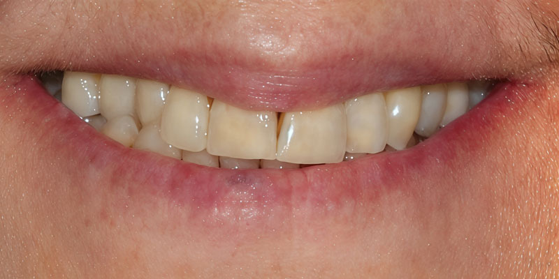 Before: worn anterior crowns with a reverse smile