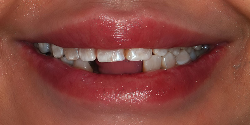 Before: failing dentition needing full-mouth reconstruction